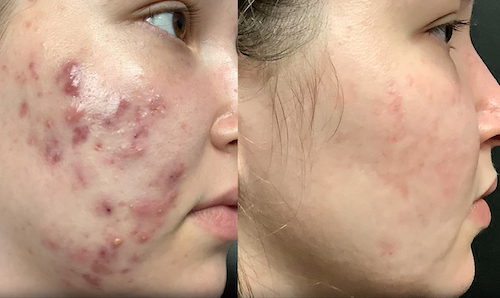 aviclear before after results mississauga oakville